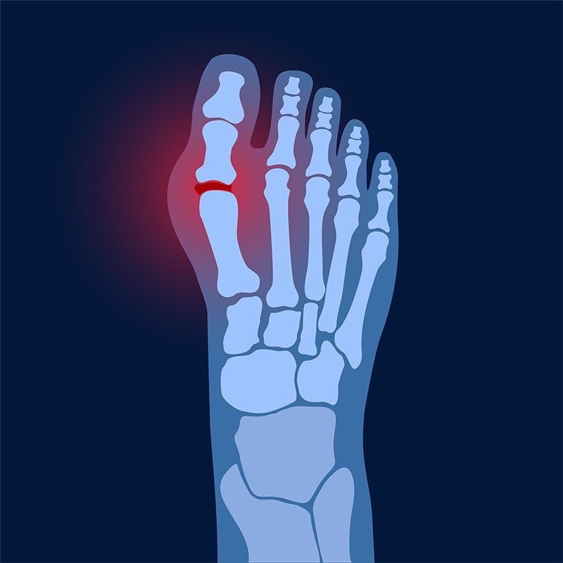 ¿Cómo tratar la artrosis en los pies?